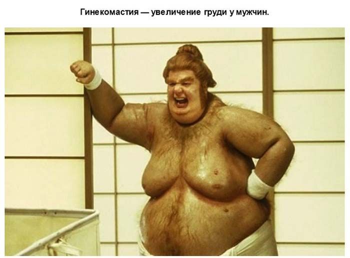 Что такое гинекомастия
